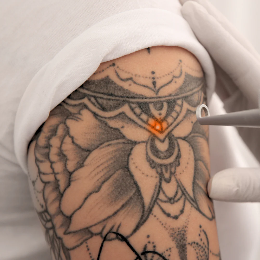 Laser Tattoo in Dallas and frisco