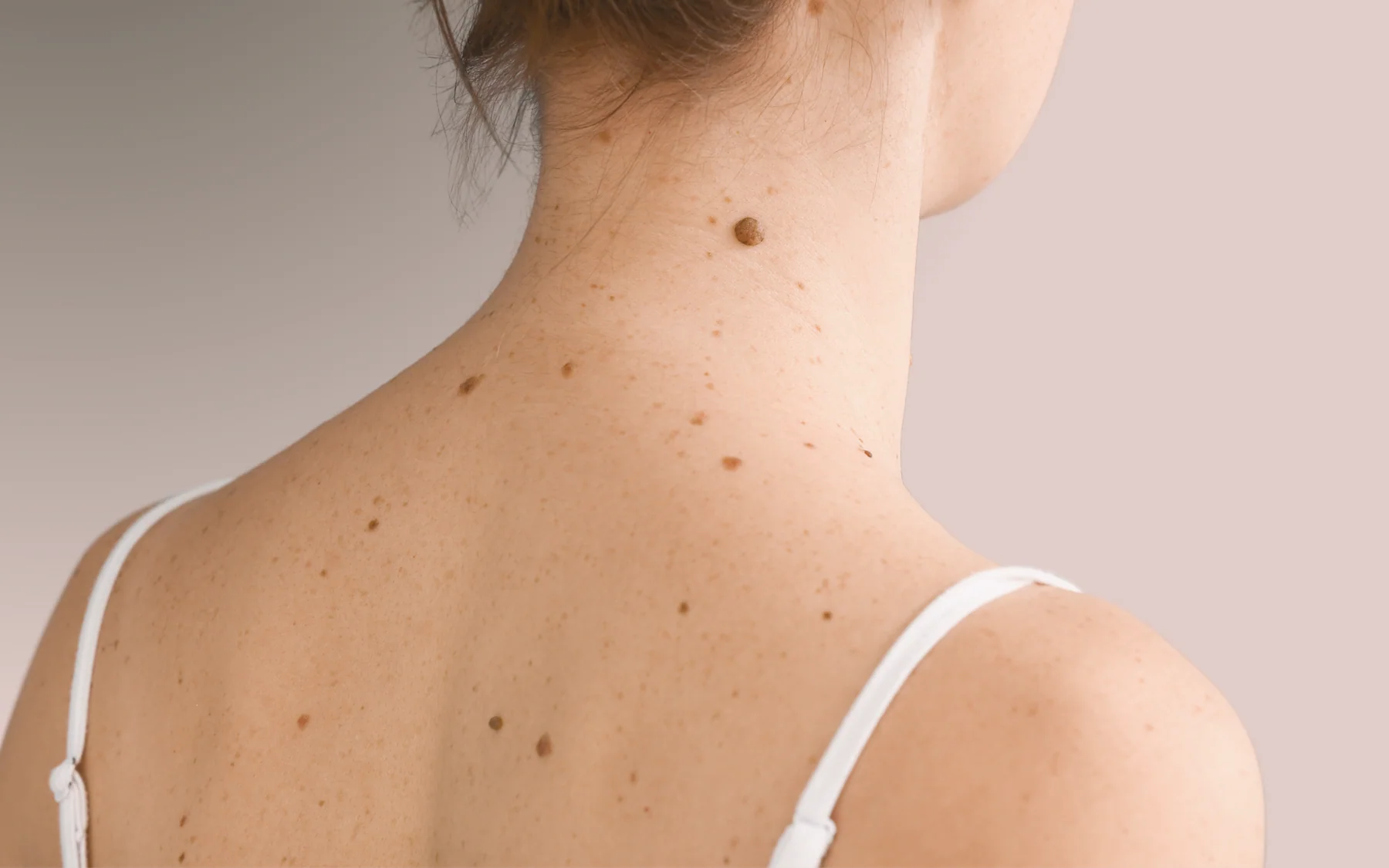 CryoPen Skin Lesion Removal at Renew Beauty Med Spa