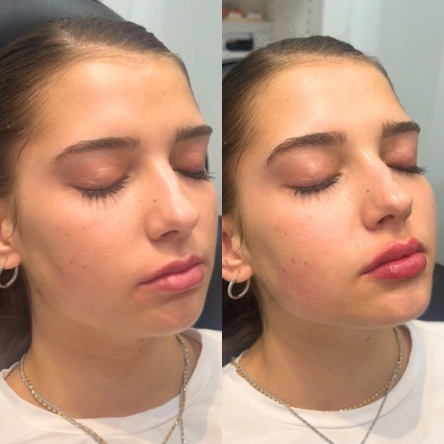 botox-briston-02: Before & After